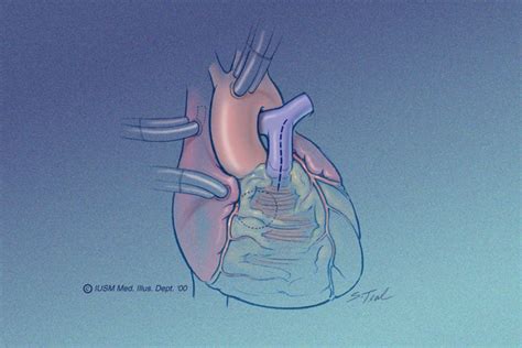 Ptfe Monocusp Valve For Rvot Reconstruction Ctsnet