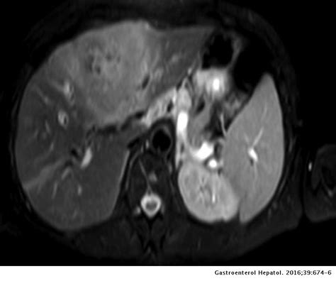 Primary Hepatic Lymphoma An Infrequent Focal Liver Tumour