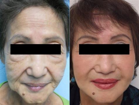 Facial Rejuvenation Without Surgery Temecula Ca Dr Kelly Oneil
