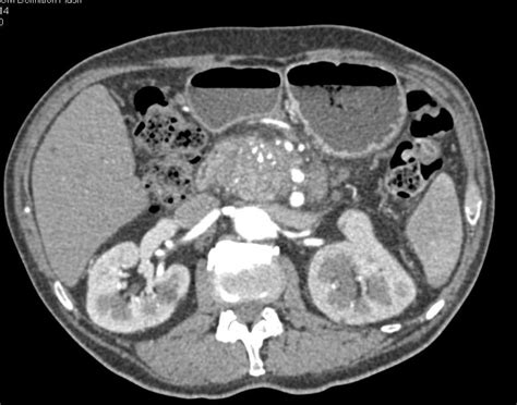 Chronic Pancreatitis With Pseudocyst Extends Into The Spleen Pancreas