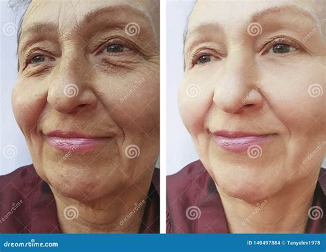 Elderly Woman`s Wrinkles Mature Correction Results Contrast Before And