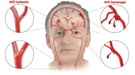 Accident vascular cerebral AVC Simptome tratament și recuperare