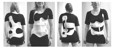 Scoliosis Treatment With Scoliosis Brace Provital Prosthesis Clinic