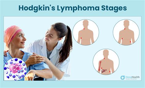 Hodgkin S Lymphoma Symptoms Causes Stages Treatment