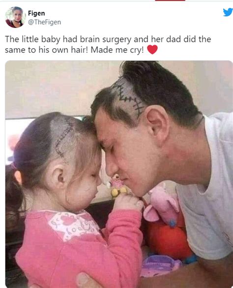 بیٹی کے دماغ کی سرجری کے بعد باپ نے بھی اُسی طرح بال کٹوا لیے ۔۔ باپ اور بیٹی کی محبت بھری تصویر