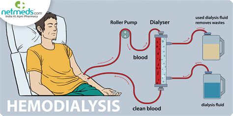 Hemodialysis Living With The Procedure Side Effects And Precautions