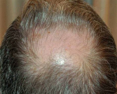 Bald Spot On Crown How To Spot It And How To Stop It