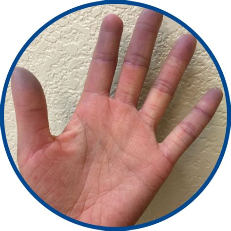 Raynauds Phenomenon And Scleroderma Complications And Treatments