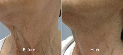 Laser Skin Resurfacing In Tulsa Ok At Skin Care Institute