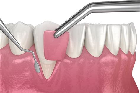 What Happens In A Gum Graft Procedure From A Periodontist