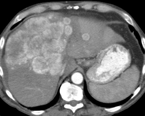 Liver Lesions On Ct Scan