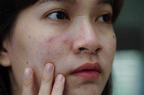 Acne Pimple And Scar On Skin Face Disorders Of Sebaceous Glands