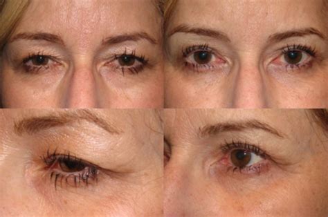 Blepharoplasty Beverly Hills Ca Cosmetic Eyelid Surgery Beverly Hills Ca