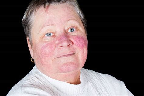 610 Psoriasis Face Stock Photos Pictures And Royalty Free Images Istock