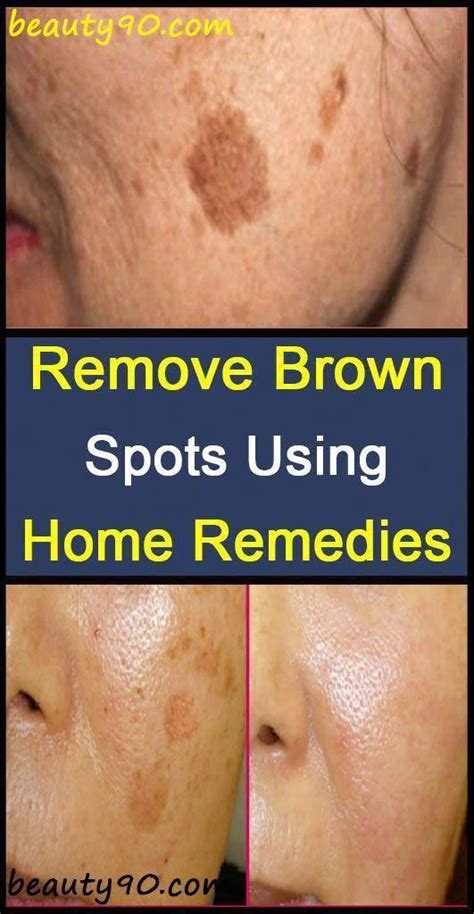 How To Get Rid Of Brown Spots On Experience Smallbrownspotsonface