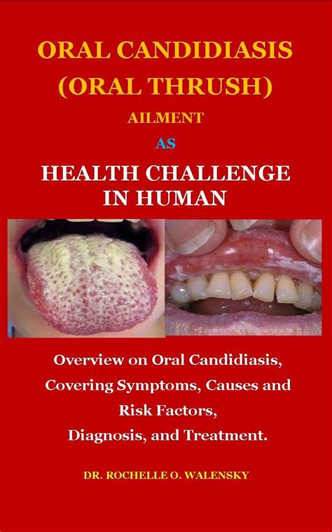 Oral Candidiasis Oral Thrush Ailment As Health Challenge In Human Overview On Oral
