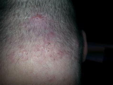 Spots And Boil Type Things On The Back Of My Neck General Acne