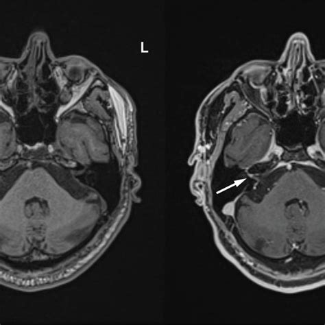 Axial T1 Weighted Pre Contrast Left And T1 Weighted Fat Saturated