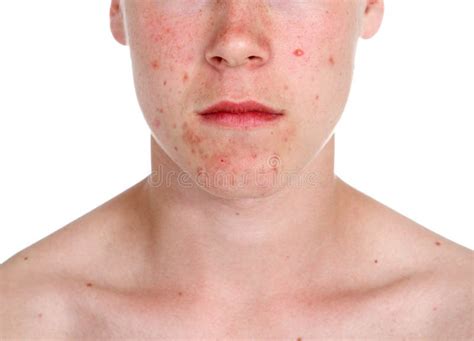 Teenage Boy With Acne Stock Photo Image Of Growth Skin 17769488