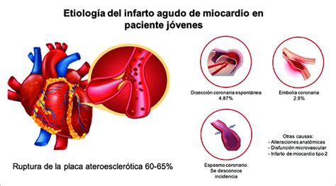 Esquema De Las Principales Causas Del Infarto Agudo De Miocardio En