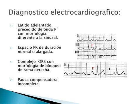 Extrasístoles Auriculares