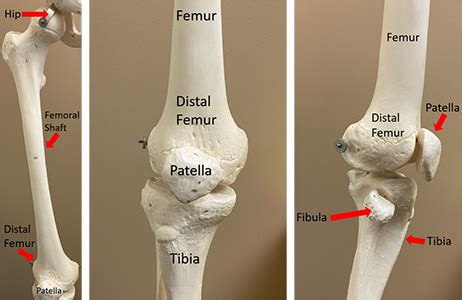 Distal femur fractures are fractures including condyles of femur or in supracondylar region which classification of distal femur fractures ao/asif. Periprosthetic Distal Femur Fracture | Orthopaedic Trauma ...