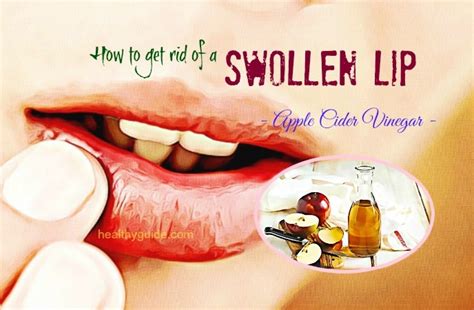 22 Tips How To Get Rid Of A Swollen Lip From A Cold Sore And Pimple Fast