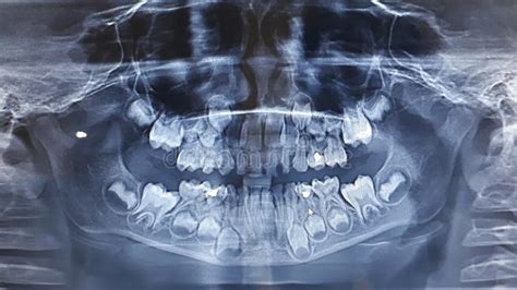 X Ray Of The Teeth Of A Five Year Old Child The Growth Of Permanent