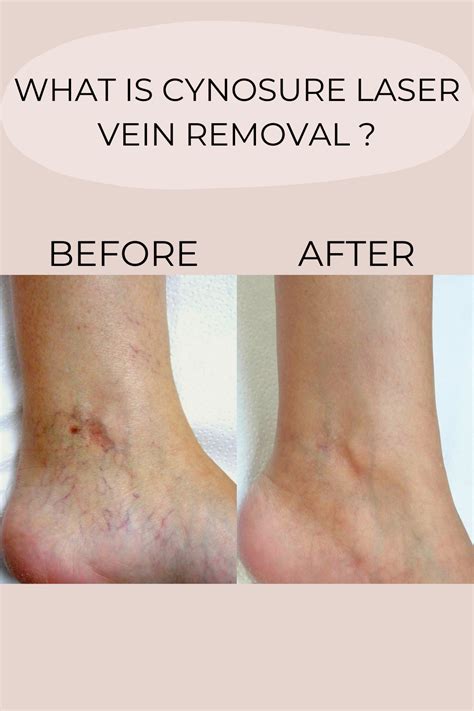 Laser Vein Removal Is A Non Surgical Procedure That Targets Unwanted