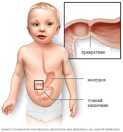 Gastroenteritis is a gut infection. Стеноз привратника желудка (пилоростеноз) у детей ...