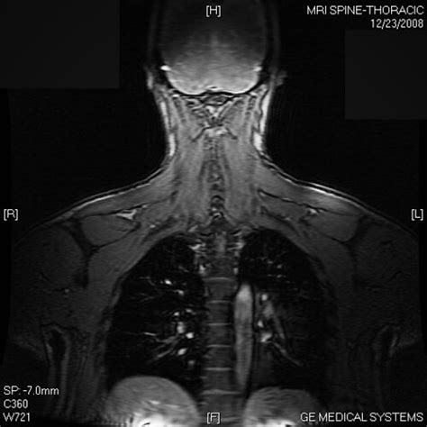 Back Thoracic Mri A Shot Of Back Muscle And A Peek Into Flickr