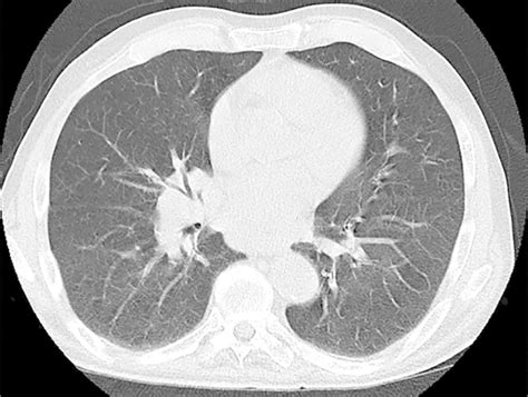 Highresolution Ct Hrct Of The Chest Showing Hilar Lymphadenopathy