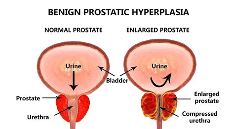 Enlarged Prostate What To Ask Your Doctor Information Kienitvc Ac Ke