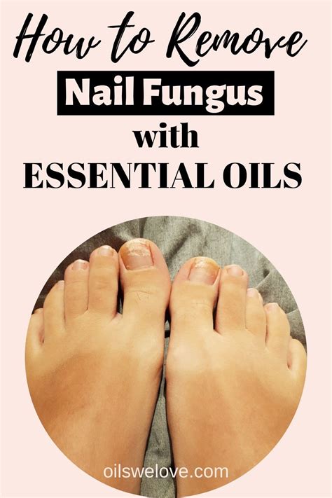 What Are The Best Essential Oils For Nail Fungus Nail Fungus Best