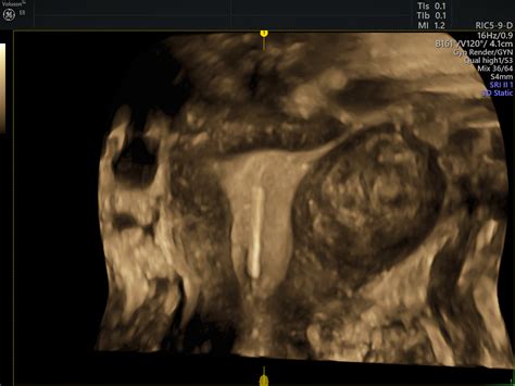 Treatment And Monitoring Via Ultrasound For Uterine Fibroids