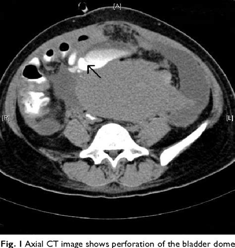 Figure 1 From Two Cases Of Intraperitoneal Bladder Rupture Following