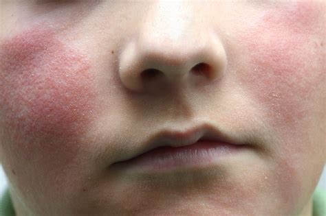 Skin Rashes In Children Nhsuk