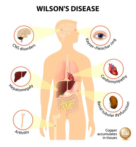 Wilson Disease Medlineplus Genetics