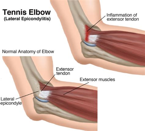 Overuse Injuries De Quervains Or Tennis Elbow Re Wired Hand Therapy