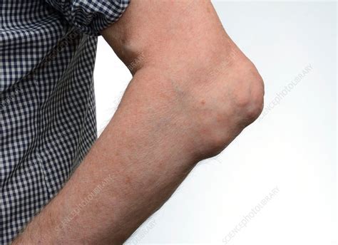 Gout Tophi In The Elbow Stock Image C0142460 Science Photo Library