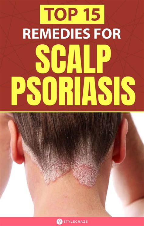 12 Best Home Remedies To Improve Scalp Psoriasis Effectively Scalp