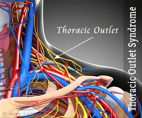 Thoracic Outlet Syndrome Symptoms Diagnosis Treatment Remedies