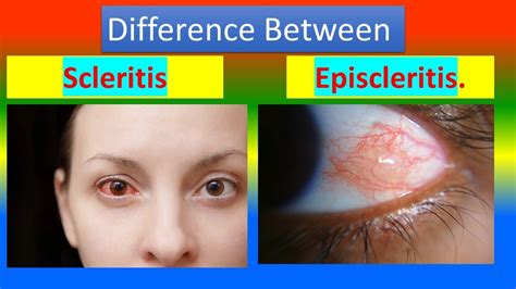 Difference Between Scleritis And Episcleritis Youtube