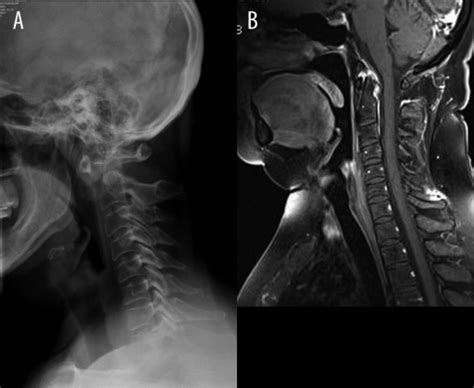Also, a ct scan can have a potential reaction to the use of contrast dyes. Dislocation of the atlanto-axial joint, axis tooth eros ...