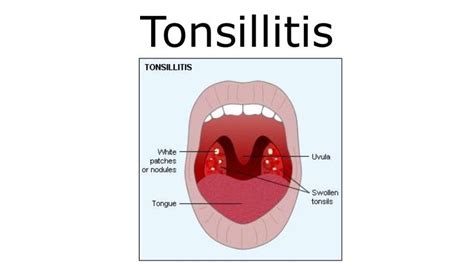 Pathophysiology Of Tonsillitis