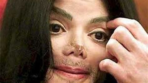 La Autopsia Revela Que Michael Jackson Tenía Una Enfermedad Real De La Piel