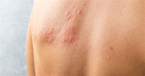 5 Facts About Shingles Rush