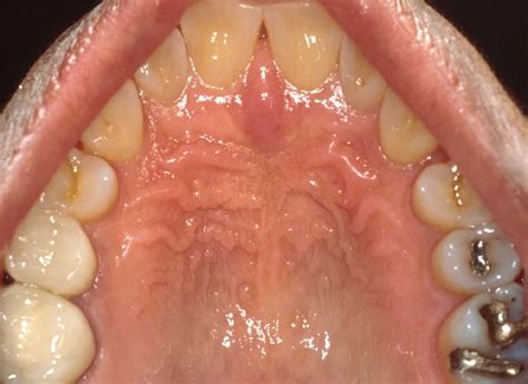 Photos Of Oral Cancer On Roof Of Mouth