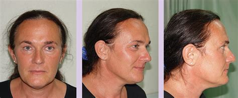 dr chettawut sex reassignment and facial feminization surgery center facial feminization