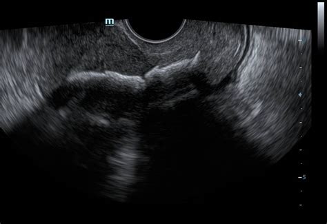 Gynaecological Ultrasound Archives Scholarmd